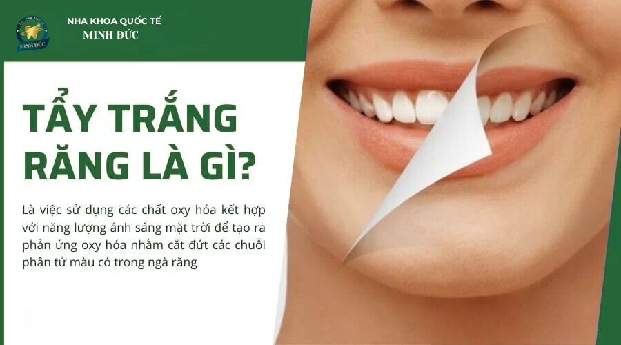 Tẩy trắng răng là gì?