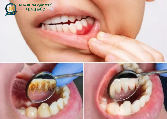 Điều trị nha chu