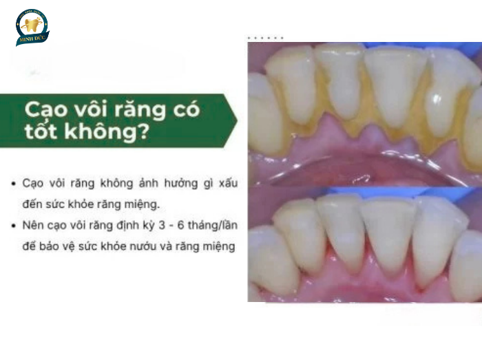 Cạo vôi răng có tốt không?